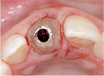Options for Immediate Temporization