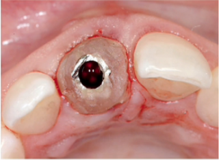 Options for Immediate Temporization FrankSpear options for immediate temporization Fig.1