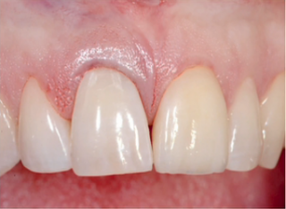 Options for Immediate Temporization FrankSpear options for immediate temporization Fig.2