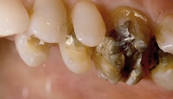 When Cuspal Coverage Is More Appropriate FrankSpear when cuspal coverage is more appropriate Fig.1