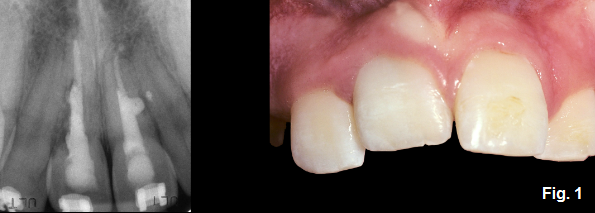 Ankylosis Part IV: The Use of Decoronation Greggory Kinzer Ankylosis Part IV The Use of Decoronation Figure 1