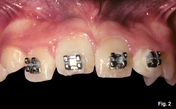 Ankylosis Part IV: The Use of Decoronation Greggory Kinzer Ankylosis Part IV The Use of Decoronation Figure 2
