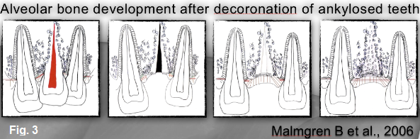 Ankylosis Part IV: The Use of Decoronation Greggory Kinzer Ankylosis Part IV The Use of Decoronation Figure 3