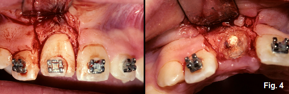Ankylosis Part IV: The Use of Decoronation Greggory Kinzer Ankylosis Part IV The Use of Decoronation Figure 4
