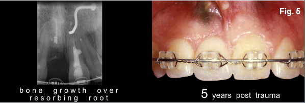 Ankylosis Part IV: The Use of Decoronation Greggory Kinzer Ankylosis Part IV The Use of Decoronation Figure 5