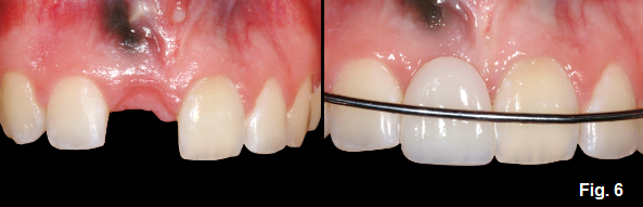 Ankylosis Part IV: The Use of Decoronation Greggory Kinzer Ankylosis Part IV The Use of Decoronation Figure 6