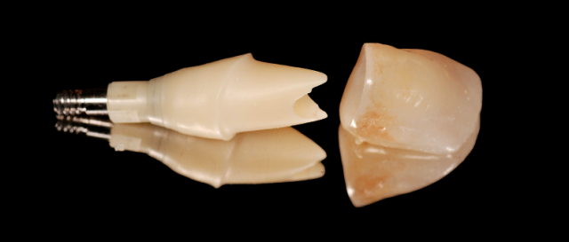 How to Achieve Success with Custom Zirconia Abutments Greggory Kinzer How to Achieve Success with Custom Zirconia Abutments Figure 1