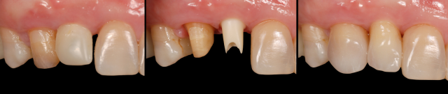 How to Achieve Success with Custom Zirconia Abutments Greggory Kinzer How to Achieve Success with Custom Zirconia Abutments Figure 2