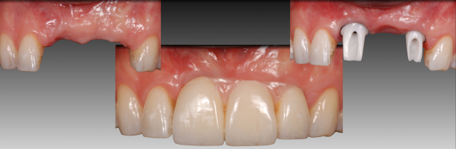 How to Achieve Success with Custom Zirconia Abutments Greggory Kinzer How to Achieve Success with Custom Zirconia Abutments Figure 4