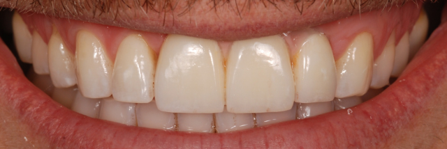 How to Achieve Success with Custom Zirconia Abutments Greggory Kinzer How to Achieve Success with Custom Zirconia Abutments Figure 5