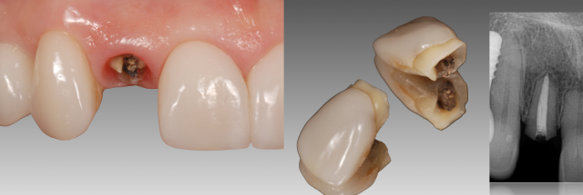 The Abutment Option Most Dentists Overlook Greggory Kinzer The Abutment Option Most Dentists Overlook Figure 2