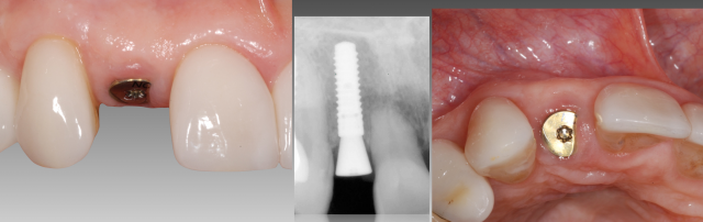 The Abutment Option Most Dentists Overlook Greggory Kinzer The Abutment Option Most Dentists Overlook Figure 3