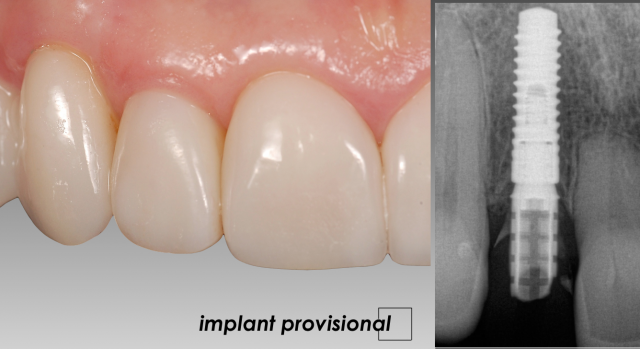 The Abutment Option Most Dentists Overlook Greggory Kinzer The Abutment Option Most Dentists Overlook Figure 4