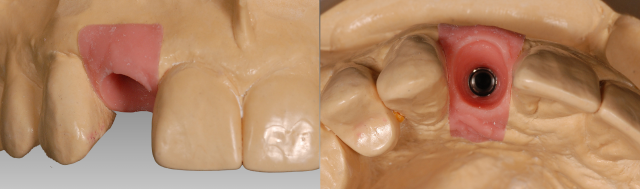 The Abutment Option Most Dentists Overlook Greggory Kinzer The Abutment Option Most Dentists Overlook Figure 5