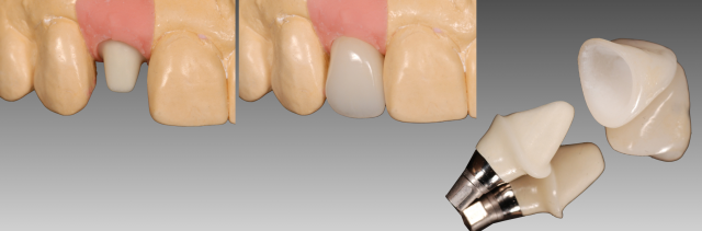 The Abutment Option Most Dentists Overlook Greggory Kinzer The Abutment Option Most Dentists Overlook Figure 6