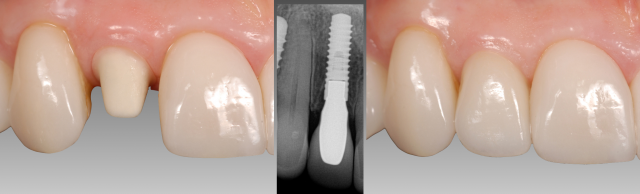 The Abutment Option Most Dentists Overlook Greggory Kinzer The Abutment Option Most Dentists Overlook Figure 7