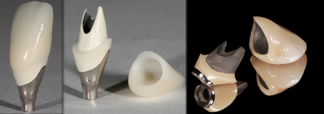 The Abutment Option Most Dentists Overlook Greggory Kinzer The Abutment Option Most Dentists Overlook Figure 8