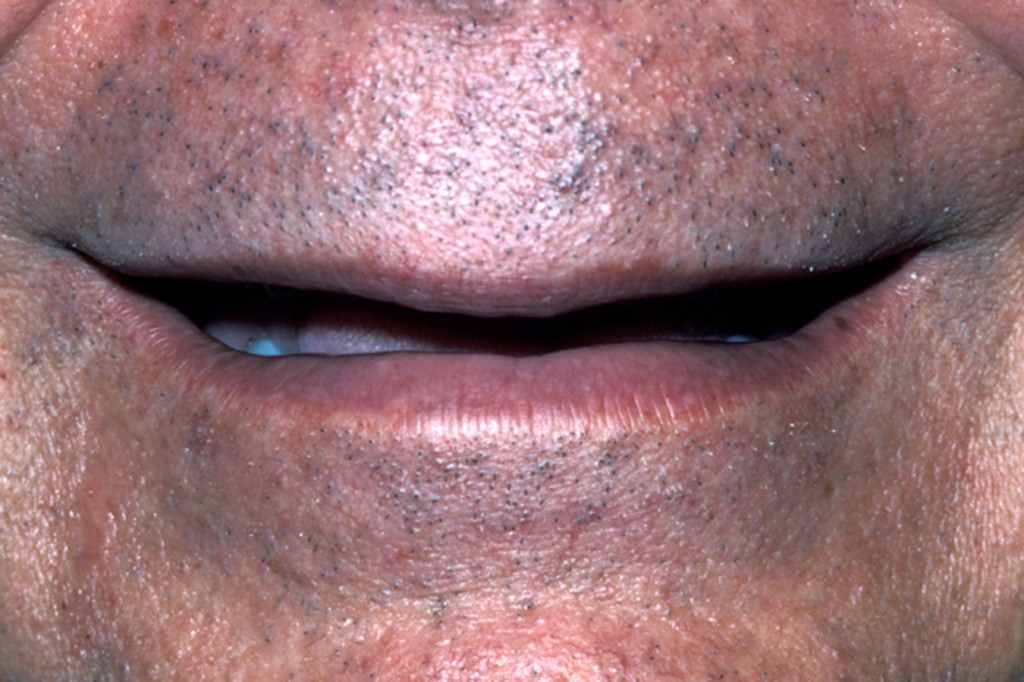 The Occlusal Plane Guide Greggory Kinzer The Occlusal Plane Guide Featured Image