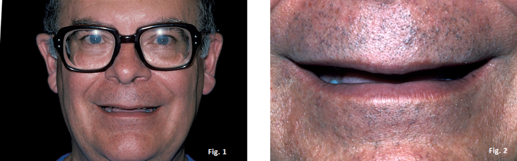 The Occlusal Plane Guide Greggory Kinzer The Occlusal Plane Guide Figure 1 2