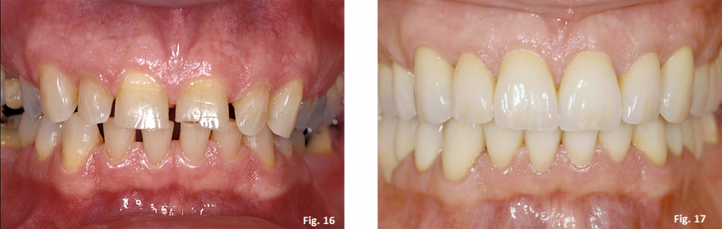 The Occlusal Plane Guide Greggory Kinzer The Occlusal Plane Guide Figure 16 17