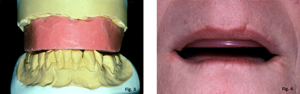 The Occlusal Plane Guide Greggory Kinzer The Occlusal Plane Guide Figure 2 3