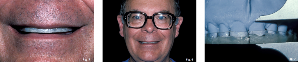 The Occlusal Plane Guide Greggory Kinzer The Occlusal Plane Guide Figure 5 6 7