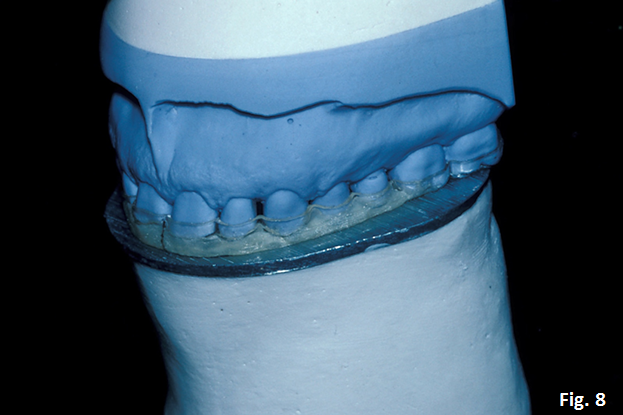 The Occlusal Plane Guide Greggory Kinzer The Occlusal Plane Guide Figure 8