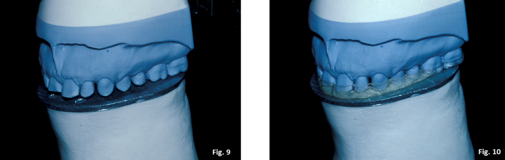 The Occlusal Plane Guide Greggory Kinzer The Occlusal Plane Guide Figure 9 10