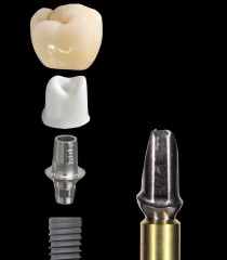 The Two-piece Custom Implant Abutment Greggory Kinzer The Two piece Custom Implant Abutment Figure 1