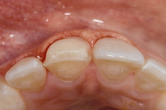 Veneer Preparations: Advantages/Disadvantages of Breaking Interproximal Contact Greggory Kinzer Veneer Preparations Figure 1