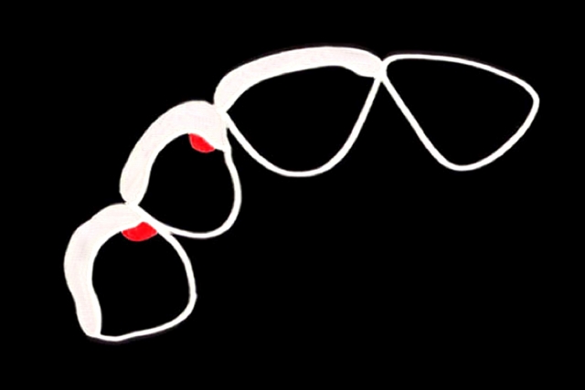 Veneer Preparations: Advantages/Disadvantages of Breaking Interproximal Contact Greggory Kinzer Veneer Preparations Figure 2