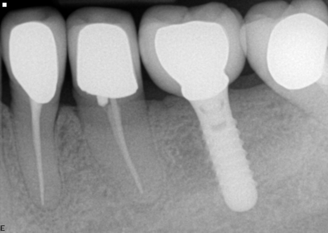 Implant Dilemma: What's Going on With Open Contacts? GreggoryKinzer implant dilemma unwanted open contacts Fig.1