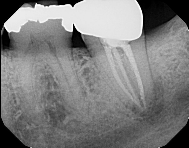 Huff Managing Cracked Teeth Featured Image