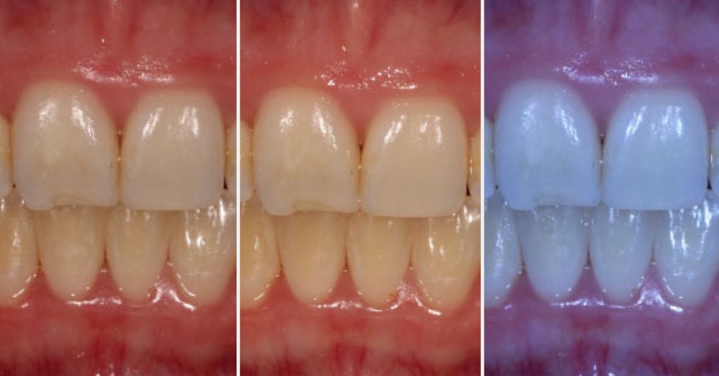 The Importance of White Balance in Dental Photography Janiga importance white balance 02