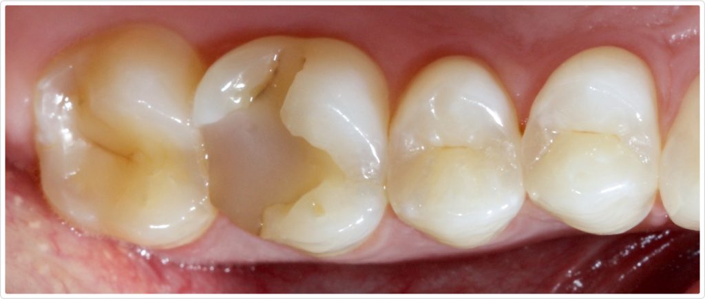 Reducing Sensitivity in Class II Direct Resin Restorations Jason Smithson Class 2 Sensitivity Fig 2