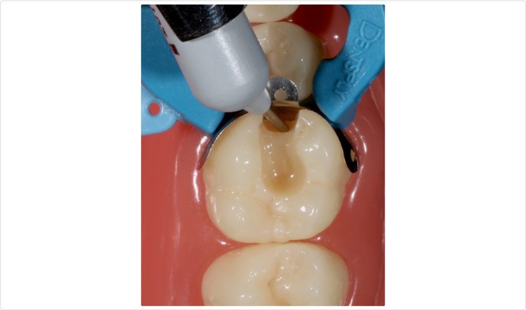 Reducing Sensitivity in Class II Direct Resin Restorations Jason Smithson Class 2 Sensitivity Fig 7