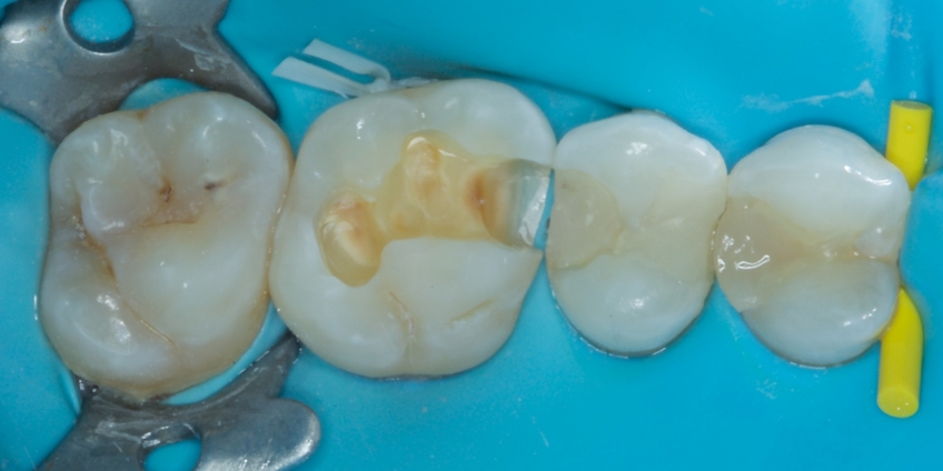 Jason Smithson Closing the Class 2 Restoration Box Part 2 Figure 2