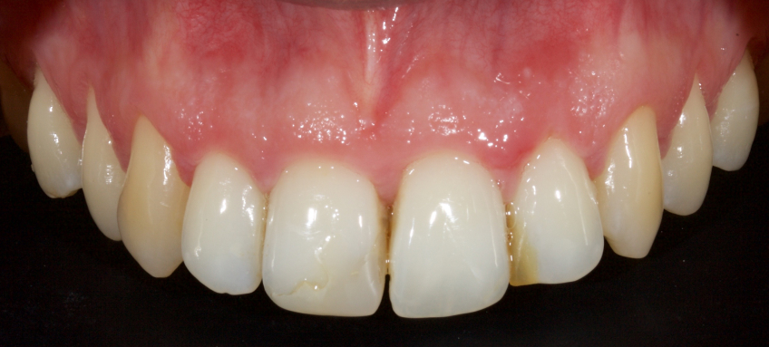 Managing the Midline Diastema Part 2: Challenges Jason Smithson Managing the Midline Diastema Part 2 Figure 1