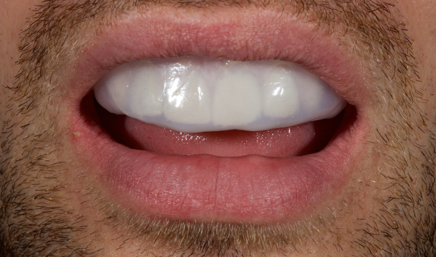 Managing the Midline Diastema Part 2: Challenges Jason Smithson Managing the Midline Diastema Part 2 Figure 10