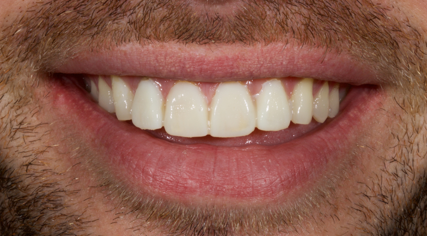 Managing the Midline Diastema Part 2: Challenges Jason Smithson Managing the Midline Diastema Part 2 Figure 11