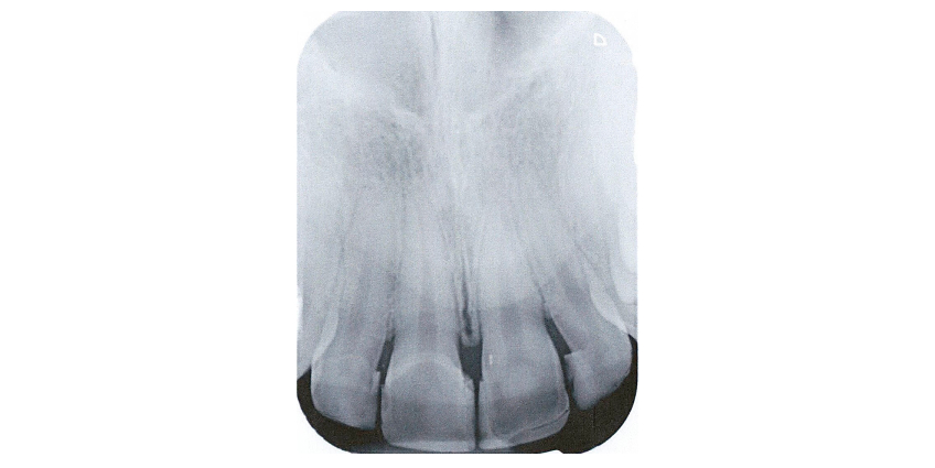 Managing the Midline Diastema Part 2: Challenges Jason Smithson Managing the Midline Diastema Part 2 Figure 12