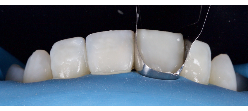 Managing the Midline Diastema Part 2: Challenges Jason Smithson Managing the Midline Diastema Part 2 Figure 15