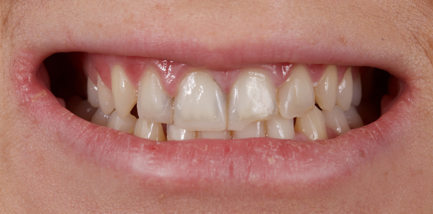 Managing the Midline Diastema Part 2: Challenges Jason Smithson Managing the Midline Diastema Part 2 Figure 16