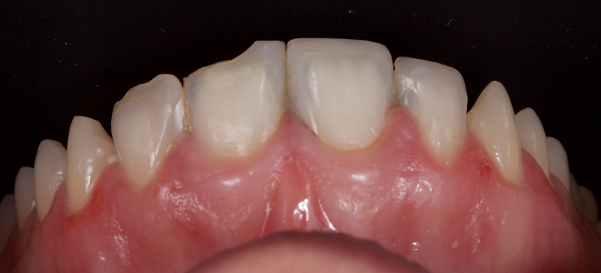 Managing the Midline Diastema Part 2: Challenges Jason Smithson Managing the Midline Diastema Part 2 Figure 17