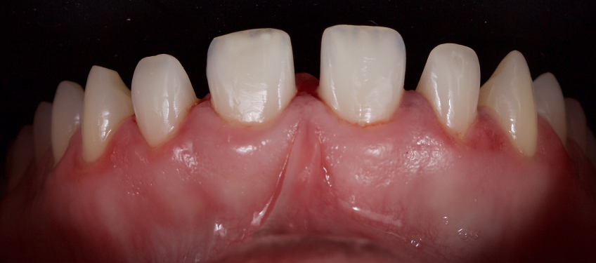 Managing the Midline Diastema Part 2: Challenges Jason Smithson Managing the Midline Diastema Part 2 Figure 18