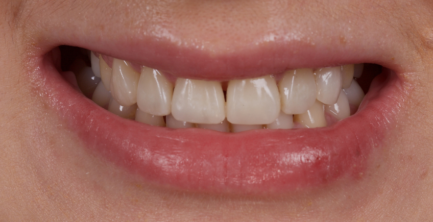 Managing the Midline Diastema Part 2: Challenges Jason Smithson Managing the Midline Diastema Part 2 Figure 19