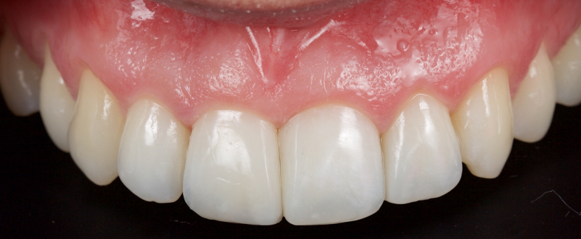 Managing the Midline Diastema Part 2: Challenges Jason Smithson Managing the Midline Diastema Part 2 Figure 2