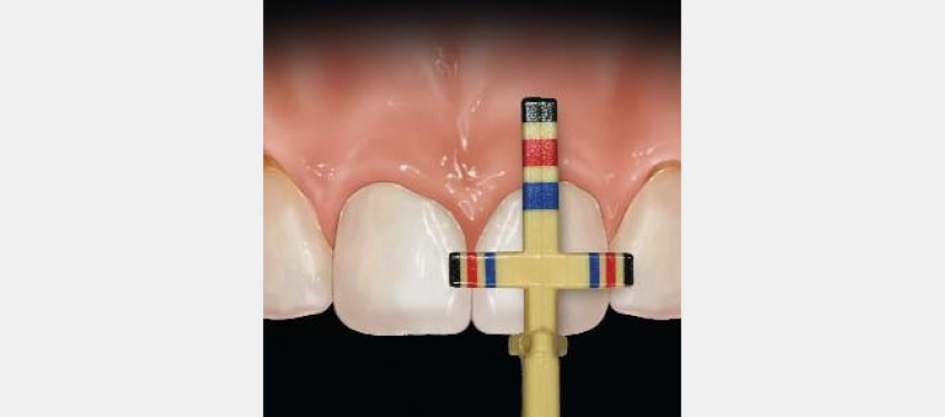 Managing the Midline Diastema Part 2: Challenges Jason Smithson Managing the Midline Diastema Part 2 Figure 7