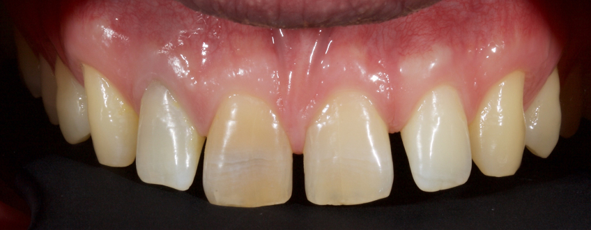 Managing the Midline Diastema Part 2: Challenges Jason Smithson Managing the Midline Diastema Part 2 Figure 8