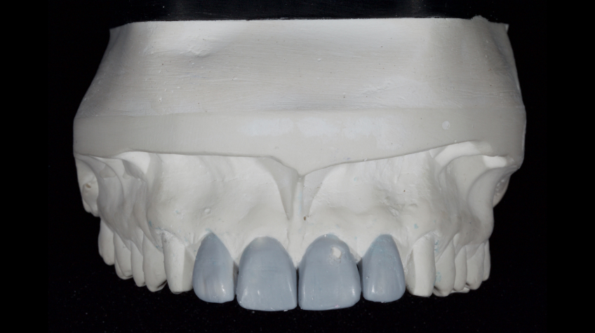 Managing the Midline Diastema Part 2: Challenges Jason Smithson Managing the Midline Diastema Part 2 Figure 9